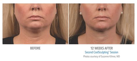 CoolSculpting® Vancouver w/ Cost Info .